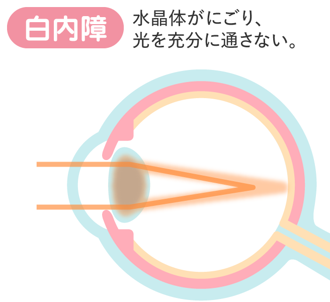 白内障