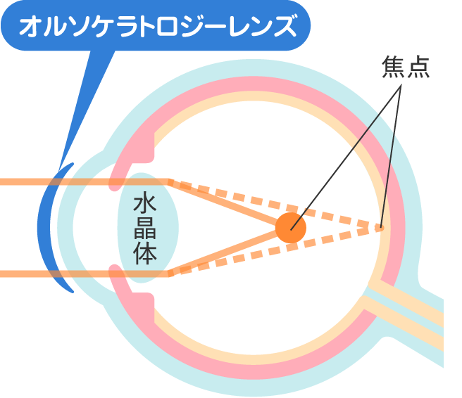 治療の仕組み 睡眠中
